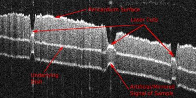 OCT-imaging for control of laser based pericard trimming